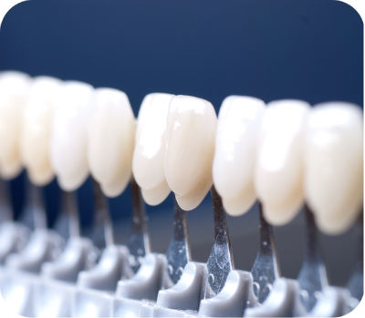 Gu�a de tonos de carillas dentales de cer�mica