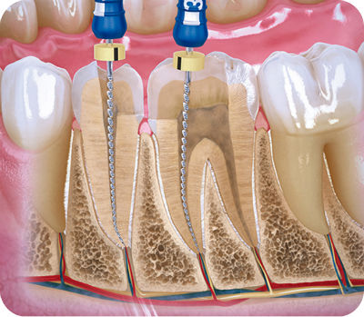 Endodoncia