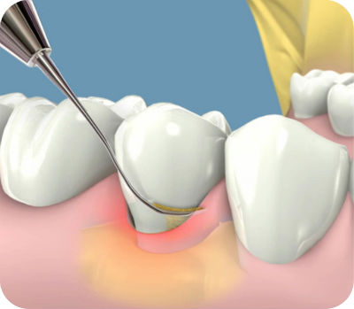 Ilustración médica 3D de un tratamiento de periodoncia, mostrando la limpieza de sarro e inflamación bajo la encía